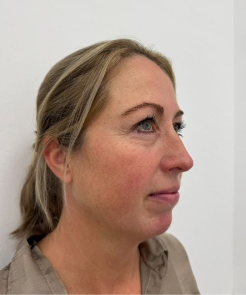 Halslift (Nefertiti) behandeling met botulinetoxine