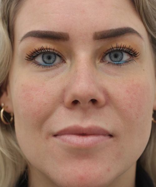 Jukbeenderen opvullen met fillers Dokterfinn