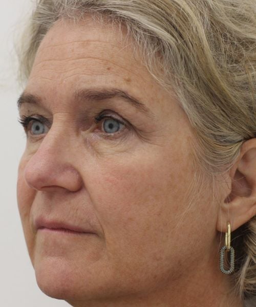Jukbeenderen opvullen met fillers bij Dokterfinn na