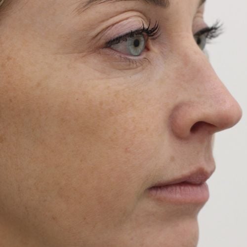 Kraaienpootjes verminderen met botulinetoxine Dokterfinn