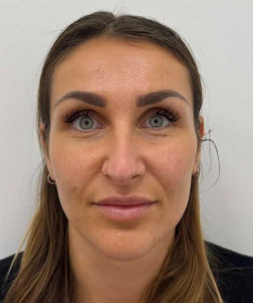 Lippen opvullen met lip fillers