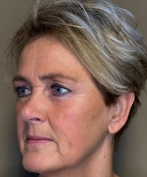 Marionetlijnen verminderen met fillers bij Dokterfinn
