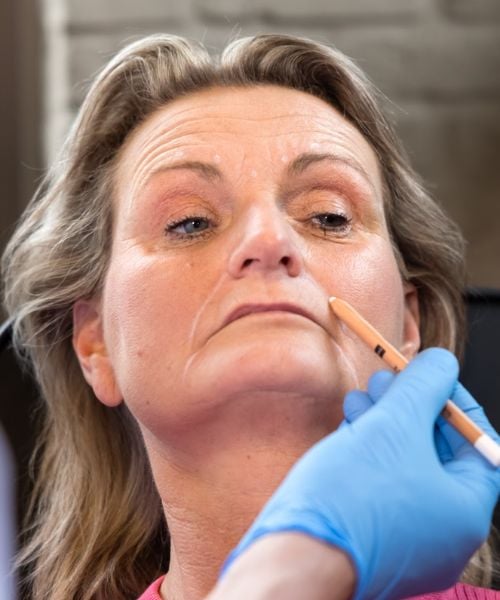 Marionetlijnen verminderen met fillers bij de Dokterfinn