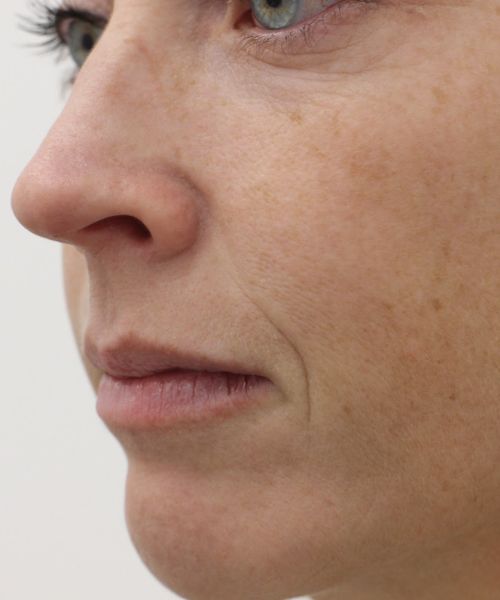 Neuslippenplooi verminderen met fillers (1)