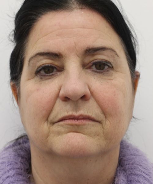 Neuslippenplooi verminderen met fillers Dokterfinn