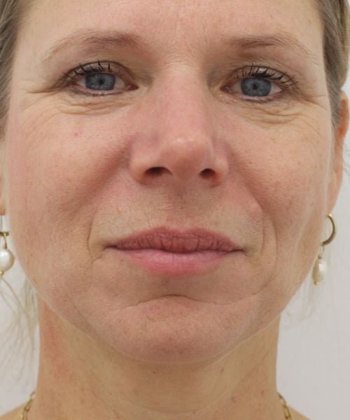 Rimpels opvullen met fillers behandeling