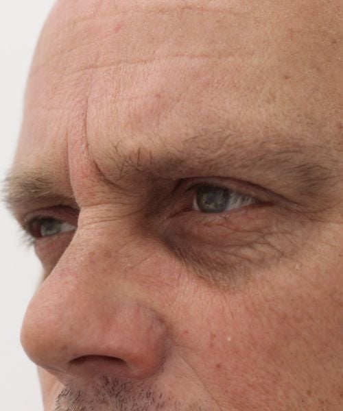 Rimpels opvullen met fillers bij Dokterfinn behandeling