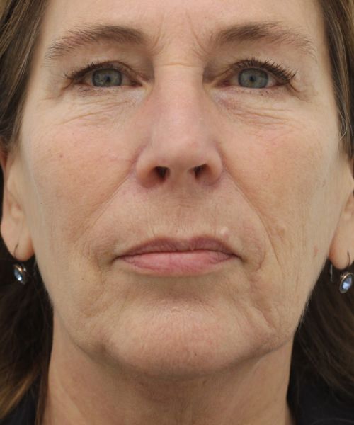 Rokerslijntjes behandelen met botulinetoxine bij Dokterfinn