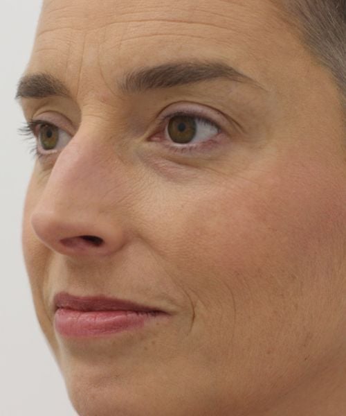 Slapen laten opvullen met fillers bij Dokterfinn