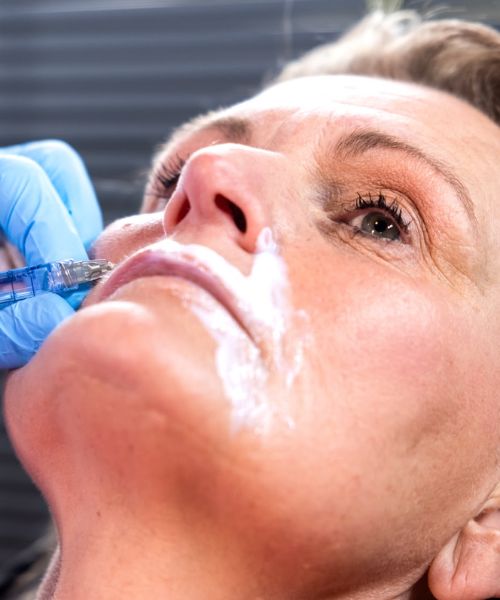 neuslippenplooi fillers